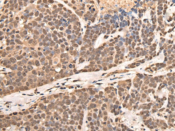 Immunohistochemistry of paraffin-embedded Human thyroid cancer tissue  using ATF7 Polyclonal Antibody at dilution of 1:40(?200)