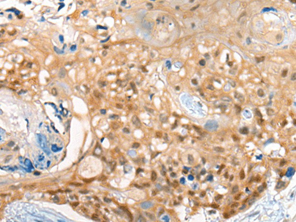 Immunohistochemistry of paraffin-embedded Human esophagus cancer tissue  using CBR3 Polyclonal Antibody at dilution of 1:35(?200)