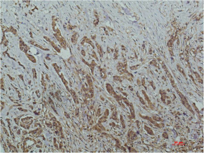 Immunohistochemistry of paraffin-embedded Human breast carcinoma tissue using HDAC1 Monoclonal Antibody at dilution of 1:200.