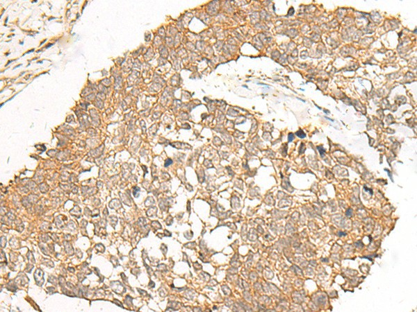 Immunohistochemistry of paraffin-embedded Human lung cancer tissue  using POLR2L Polyclonal Antibody at dilution of 1:40(?200)