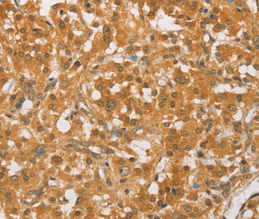 Immunohistochemistry of paraffin-embedded Human thyroid cancer tissue using CEBP beta Polyclonal Antibody at dilution 1:60