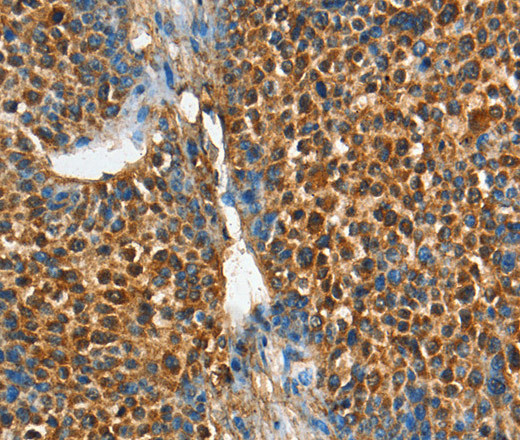 Immunohistochemistry of paraffin-embedded Human liver cancer tissue using ADCY4 Polyclonal Antibody at dilution 1:45