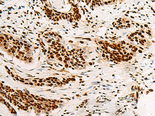 Immunohistochemistry of paraffin-embedded Human esophagus cancer tissue  using HNRNPA3 Polyclonal Antibody at dilution of 1:45(?200)