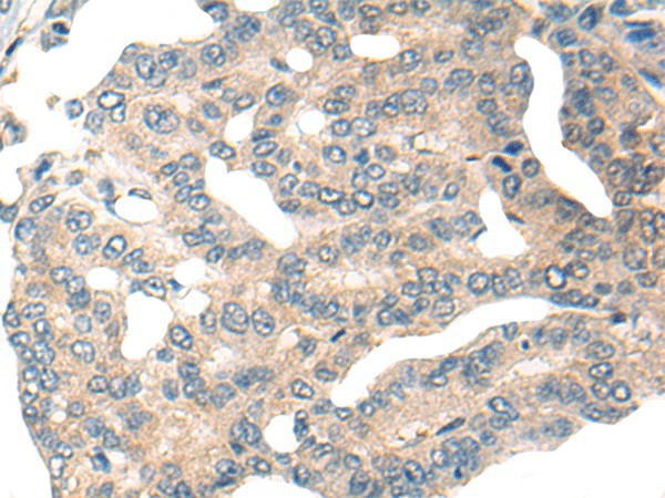 Immunohistochemistry of paraffin-embedded Human liver cancer tissue  using HIPK2 Polyclonal Antibody at dilution of 1:65(?200)