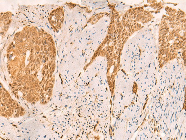 Immunohistochemistry of paraffin-embedded Human esophagus cancer tissue  using SETD1A Polyclonal Antibody at dilution of 1:25(?200)