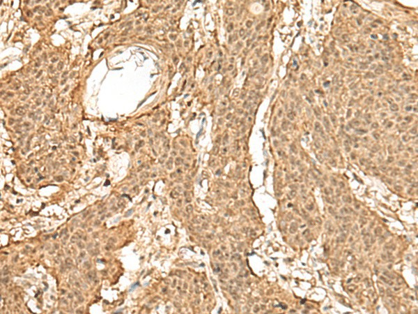 Immunohistochemistry of paraffin-embedded Human esophagus cancer tissue  using TIPRL Polyclonal Antibody at dilution of 1:60(?200)