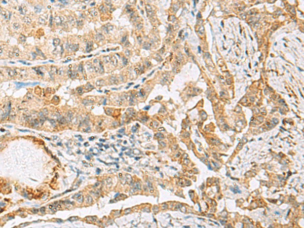 Immunohistochemistry of paraffin-embedded Human thyroid cancer tissue  using HBZ Polyclonal Antibody at dilution of 1:120(?200)