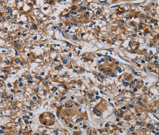 Immunohistochemistry of paraffin-embedded Human prostate cancer tissue using PLIN3 Polyclonal Antibody at dilution 1:40