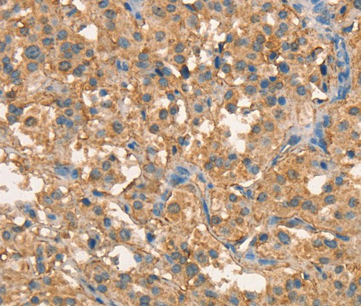 Immunohistochemistry of paraffin-embedded Human thyroid cancer tissue using CRELD1 Polyclonal Antibody at dilution 1:40