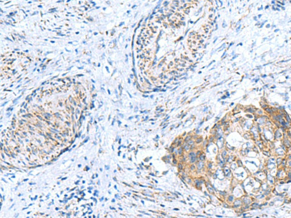 Immunohistochemistry of paraffin-embedded Human cervical cancer tissue  using GCSH Polyclonal Antibody at dilution of 1:60(?200)