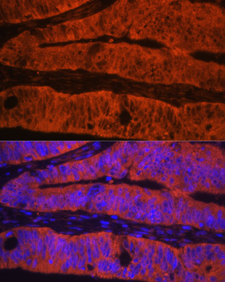 Immunofluorescence analysis of Human colon carcinoma using TLN1 Polyclonal Antibody at dilution of  1:100. Blue: DAPI for nuclear staining.