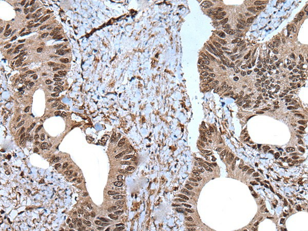 Immunohistochemistry of paraffin-embedded Human colorectal cancer tissue  using ZNF787 Polyclonal Antibody at dilution of 1:45(?200)