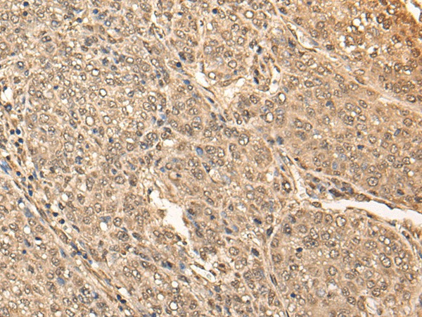 Immunohistochemistry of paraffin-embedded Human liver cancer tissue  using BRF2 Polyclonal Antibody at dilution of 1:40(?200)