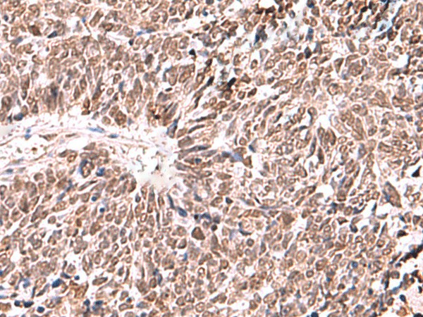 Immunohistochemistry of paraffin-embedded Human lung cancer tissue  using FDPS Polyclonal Antibody at dilution of 1:60(?200)