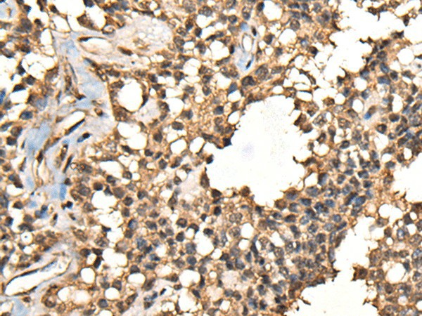 Immunohistochemistry of paraffin-embedded Human ovarian cancer tissue  using CASK Polyclonal Antibody at dilution of 1:65(?200)