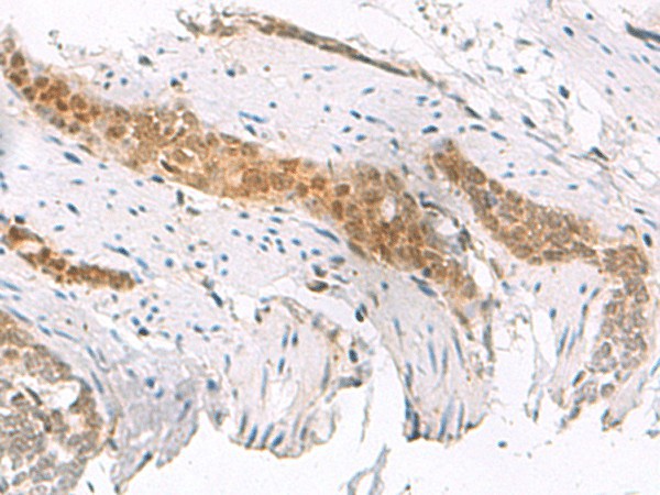 Immunohistochemistry of paraffin-embedded Human esophagus cancer tissue  using SCAND1 Polyclonal Antibody at dilution of 1:50(?200)