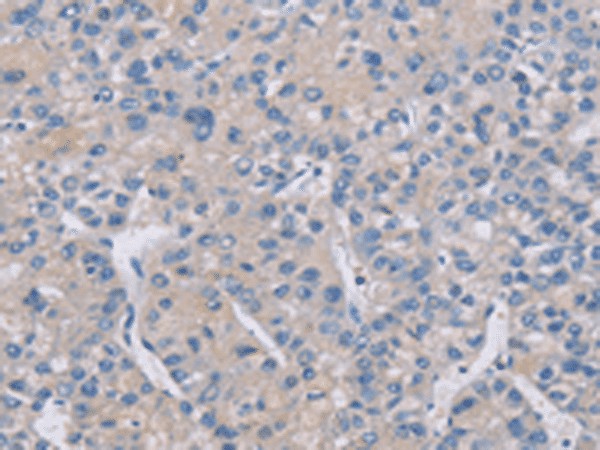 Immunohistochemistry of paraffin-embedded Human liver cancer tissue  using CREBZF Polyclonal Antibody at dilution of 1:50(?200)