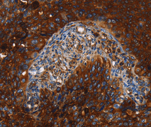 Immunohistochemistry of paraffin-embedded Human cervical cancer tissue using MSLN Polyclonal Antibody at dilution 1:40