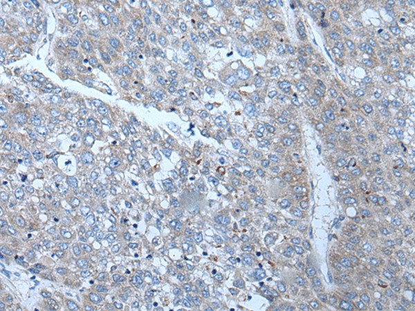 Immunohistochemistry of paraffin-embedded Human liver cancer tissue  using SLC24A5 Polyclonal Antibody at dilution of 1:50(?200)