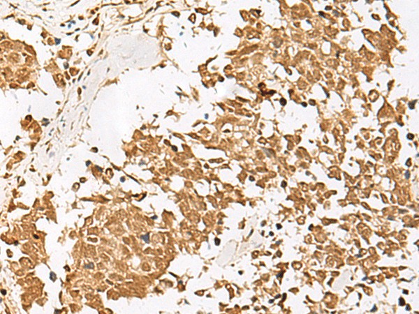 Immunohistochemistry of paraffin-embedded Human lung cancer tissue  using PSMD12 Polyclonal Antibody at dilution of 1:40(?200)