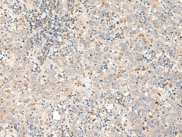 Immunohistochemistry of paraffin-embedded Human cervical cancer tissue  using GALR1 Polyclonal Antibody at dilution of 1:60(?200)