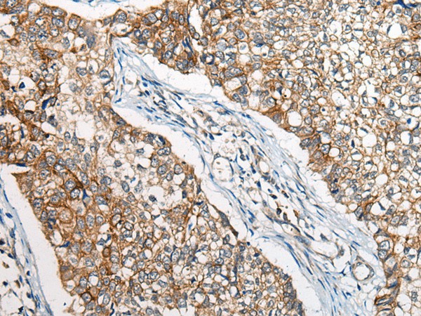 Immunohistochemistry of paraffin-embedded Human lung cancer tissue  using BBS12 Polyclonal Antibody at dilution of 1:50(?200)