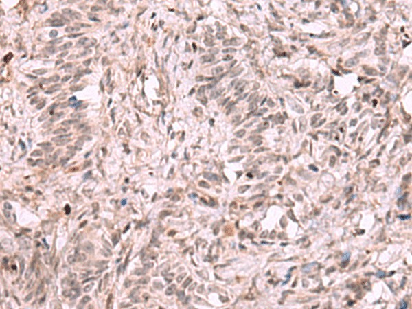 Immunohistochemistry of paraffin-embedded Human ovarian cancer tissue  using KDM7A Polyclonal Antibody at dilution of 1:35(?200)