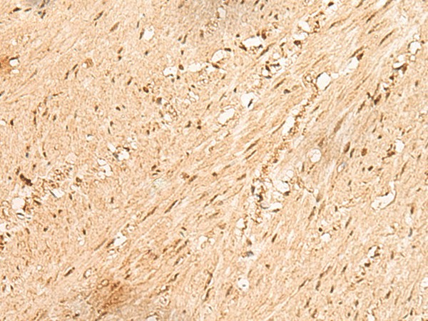 Immunohistochemistry of paraffin-embedded Human colorectal cancer tissue  using JPT2 Polyclonal Antibody at dilution of 1:80(?200)