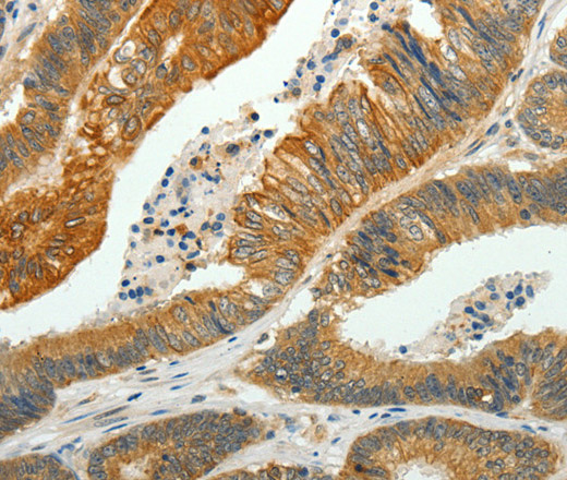 Immunohistochemistry of paraffin-embedded Human colon cancer using SH-PTP1 Polyclonal Antibody at dilution of 1:35