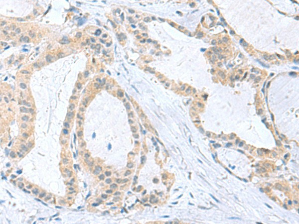 Immunohistochemistry of paraffin-embedded Human thyroid cancer tissue  using PDE6D Polyclonal Antibody at dilution of 1:50(?200)