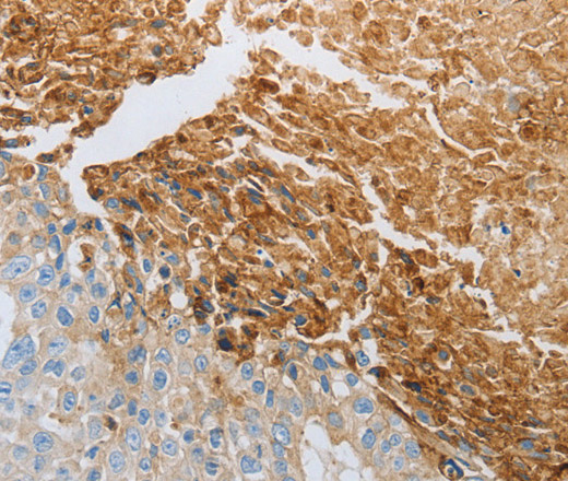 Immunohistochemistry of paraffin-embedded Human esophagus cancer tissue using RTN4 Polyclonal Antibody at dilution 1:40