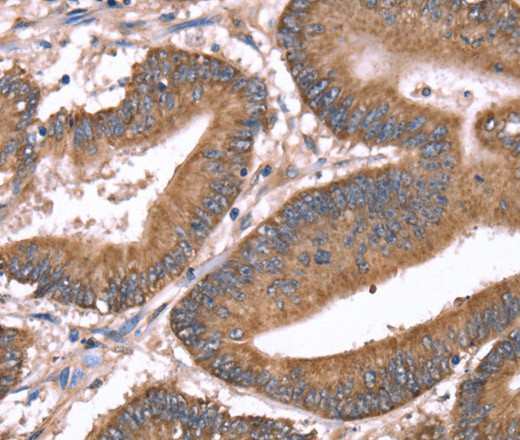 Immunohistochemistry of paraffin-embedded Human colon cancer tissue using HRG Polyclonal Antibody at dilution 1:50