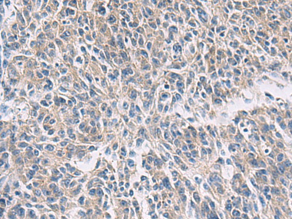 Immunohistochemistry of paraffin-embedded Human colorectal cancer tissue  using PROKR2 Polyclonal Antibody at dilution of 1:40(?200)