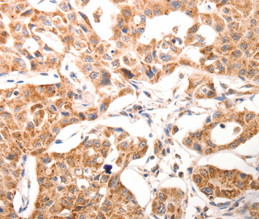 Immunohistochemistry of paraffin-embedded Human ovarian cancer tissue using BGLAP Polyclonal Antibody at dilution of 1:60