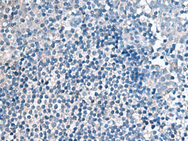 Immunohistochemistry of paraffin-embedded Human tonsil tissue  using EIF4A2 Polyclonal Antibody at dilution of 1:70(?200)