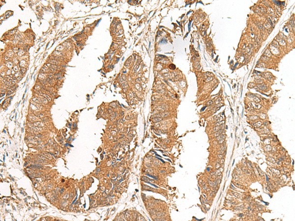 Immunohistochemistry of paraffin-embedded Human colorectal cancer tissue  using GCC2 Polyclonal Antibody at dilution of 1:50(?200)