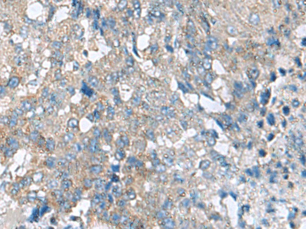 Immunohistochemistry of paraffin-embedded Human liver cancer tissue  using HPCAL1 Polyclonal Antibody at dilution of 1:70(?200)