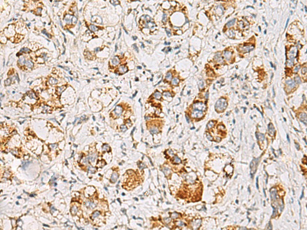 Immunohistochemistry of paraffin-embedded Human liver cancer tissue  using MMAB Polyclonal Antibody at dilution of 1:65(?200)