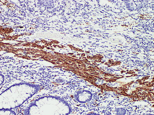 Immunohistochemistry of paraffinembedded Human colonic smooth muscle with Desmin Monoclonal Antibody(Antigen repaired by EDTA).