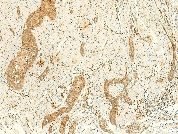 Immunohistochemistry of paraffin-embedded Human esophagus cancer tissue  using ARL4D Polyclonal Antibody at dilution of 1:50(?200)