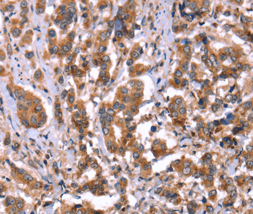 Immunohistochemistry of paraffin-embedded Human breast cancer tissue using HRG Polyclonal Antibody at dilution 1:50