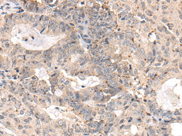 Immunohistochemistry of paraffin-embedded Human ovarian cancer tissue  using MEDAG Polyclonal Antibody at dilution of 1:75(?200)