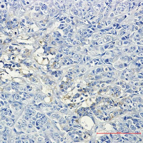 Immunohistochemistry of Hexokinase II in paraffin-embedded Human breast cancer tissue using Hexokinase II Rabbit mAb at dilution 1/50