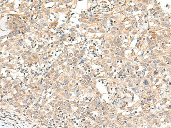 Immunohistochemistry of paraffin-embedded Human cervical cancer tissue  using FUT3 Polyclonal Antibody at dilution of 1:35(?200)