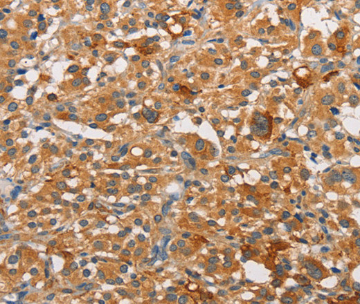 Immunohistochemistry of paraffin-embedded Human thyroid cancer tissue using PKC epsilon Polyclonal Antibody at dilution 1:30