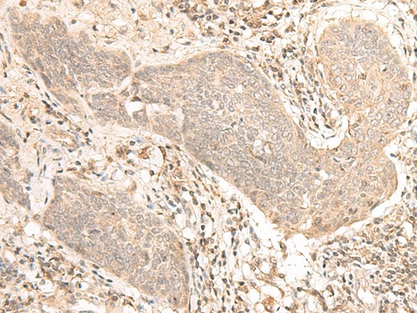 Immunohistochemistry of paraffin-embedded Human esophagus cancer tissue  using VPS50 Polyclonal Antibody at dilution of 1:30(?200)