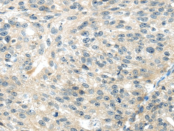 Immunohistochemistry of paraffin-embedded Human breast cancer tissue using TRAIP Polyclonal Antibody at dilution 1:40