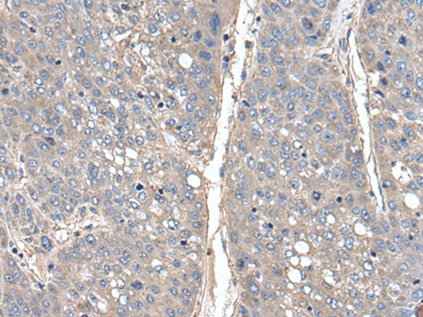 Immunohistochemistry of paraffin-embedded Human liver cancer tissue  using THAP10 Polyclonal Antibody at dilution of 1:40(?200)