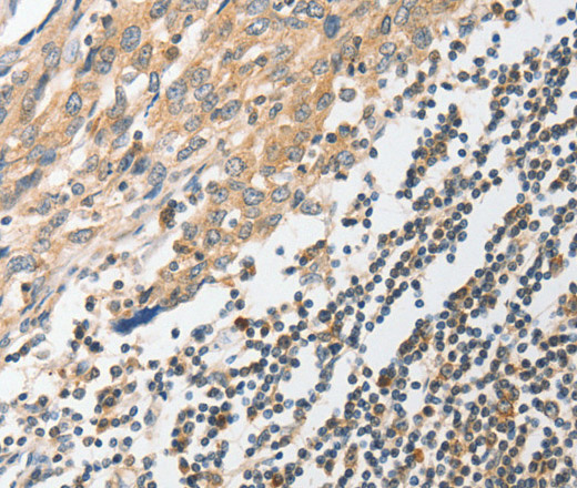 Immunohistochemistry of paraffin-embedded Human esophagus cancer tissue using STAM Polyclonal Antibody at dilution 1:40