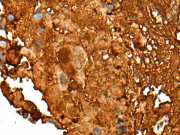 Immunohistochemistry of paraffin-embedded Human breast cancer tissue  using PEAR1 Polyclonal Antibody at dilution of 1:25(?200)